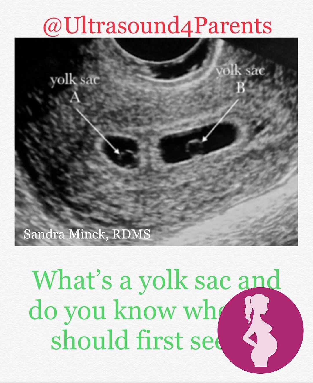 A yolk sac provides nutrients for Baby until the placenta develops. It can be seen in Week 5 of gest…