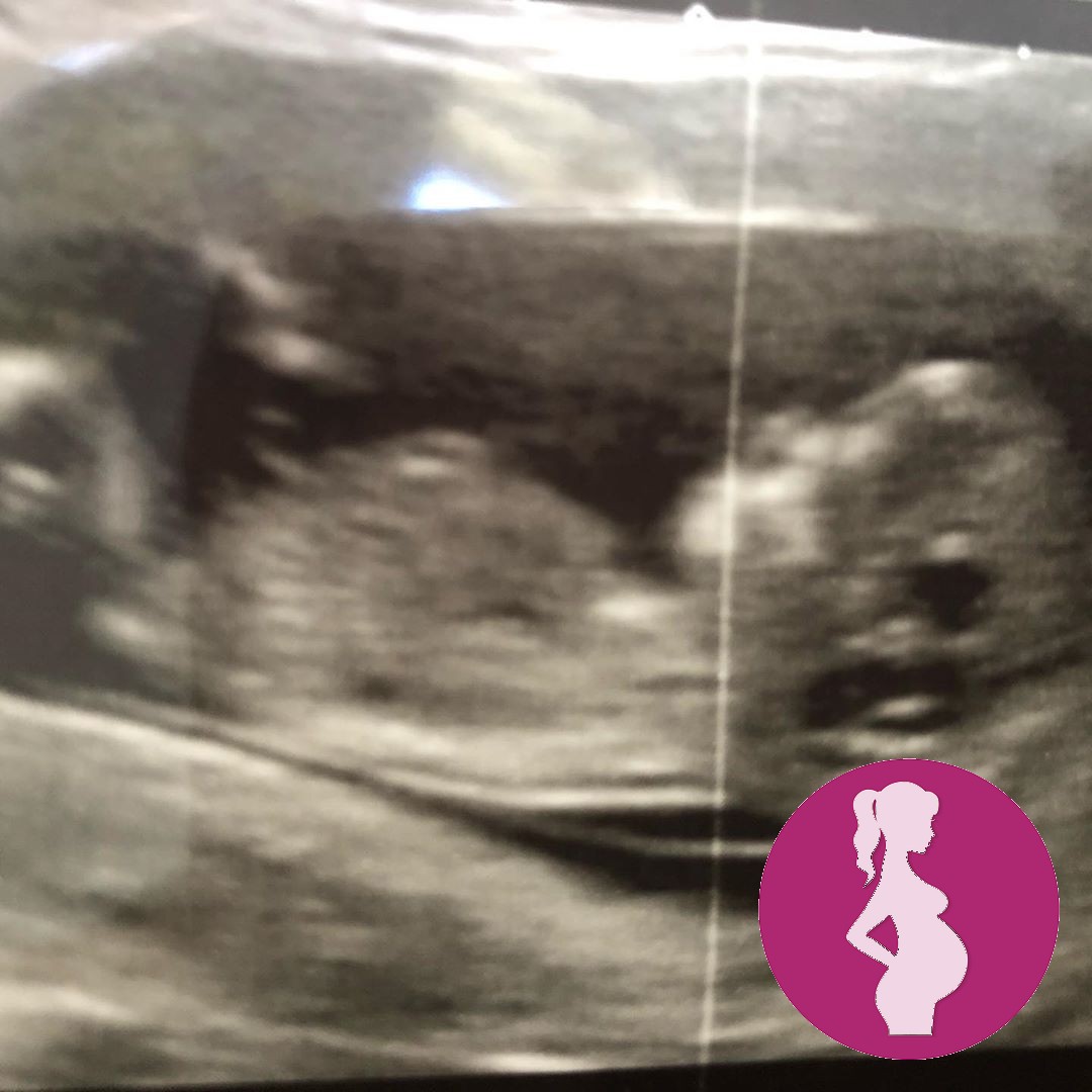 Luckiest lady in the world – Our IVF Dream at 12 weeks .ivfhope ivfmiracle ivfishard ivf iv…