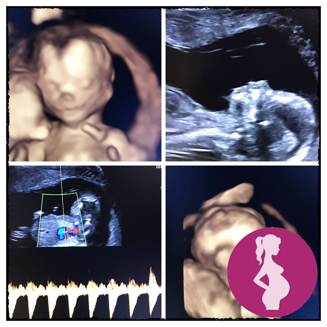 Even at 16 weeks you can see the babys features. pregnancy mummy baby genderscan numiscan pre…