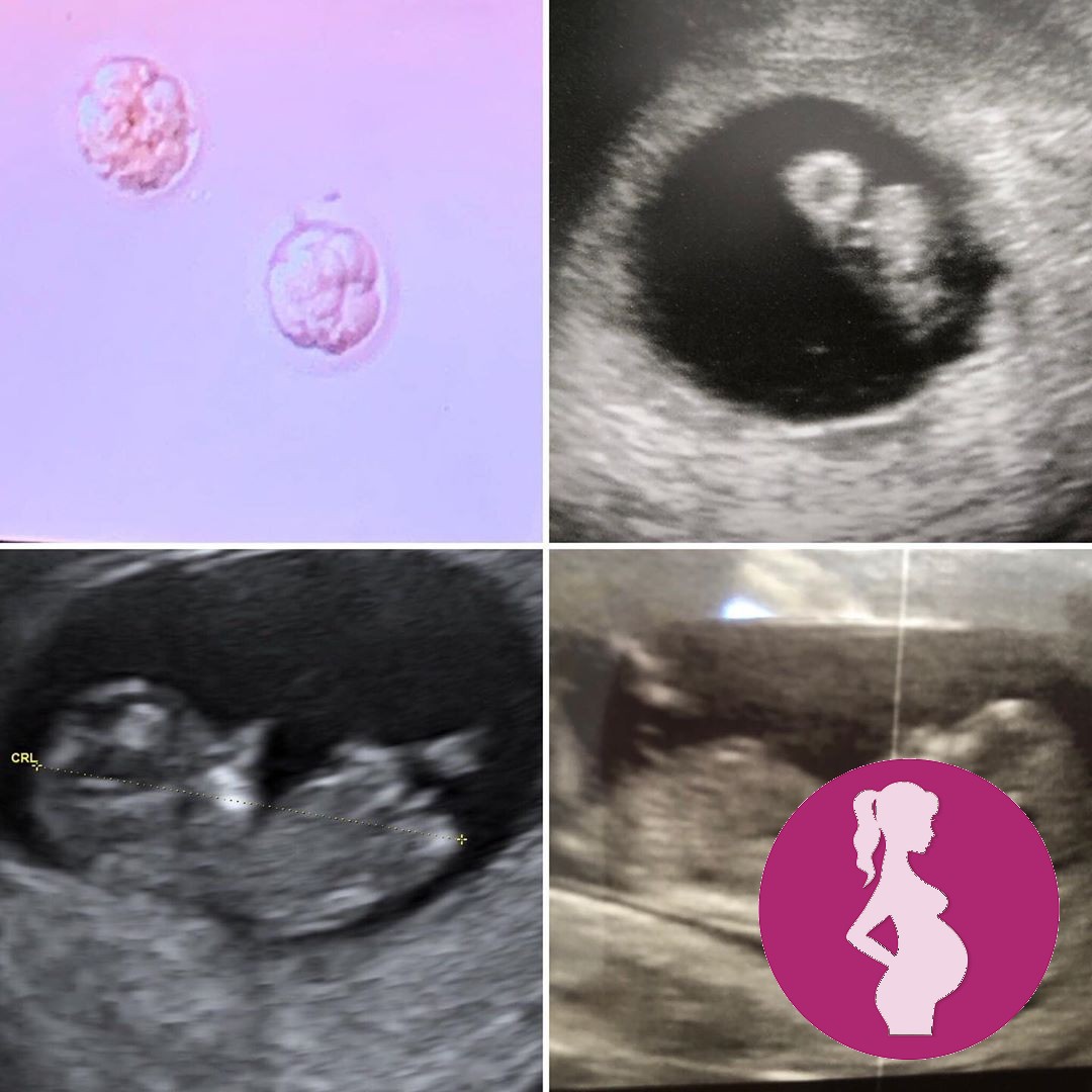 The more I look, the more I cant believe our little bumpettes development.Going through IVF has…