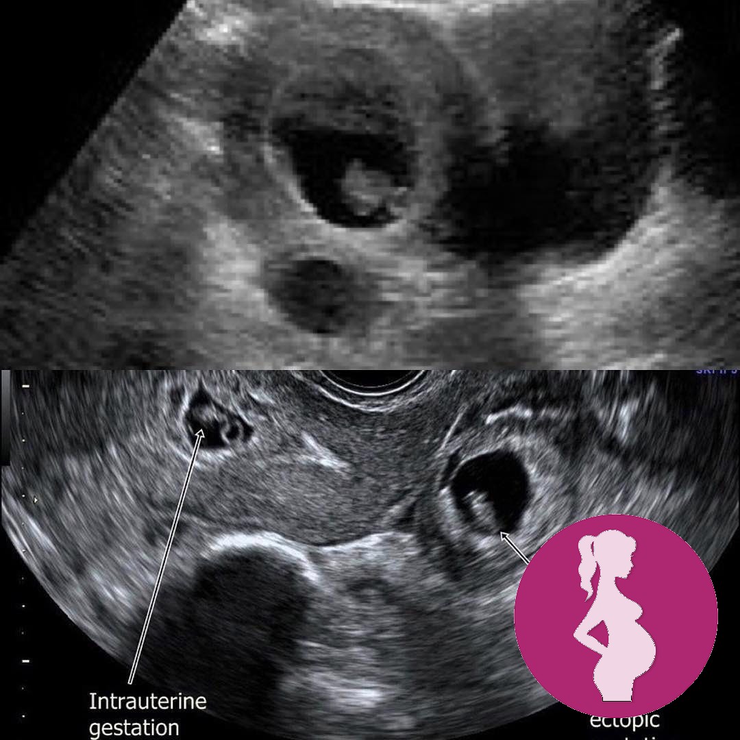 St. Ives Ikeja .This is why a TRANSVAGINAL ultrasound scan is so important in the early weeks o…