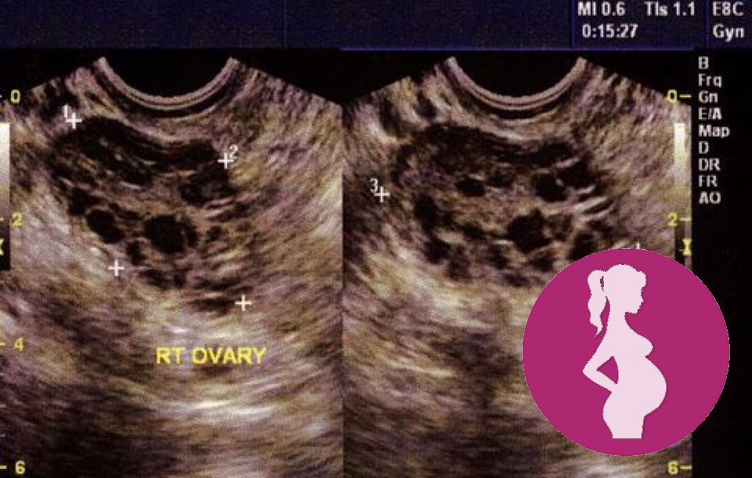 Polycystic Ovary SyndromeThe three main features of PCOS-irregular periods which means your ovar…